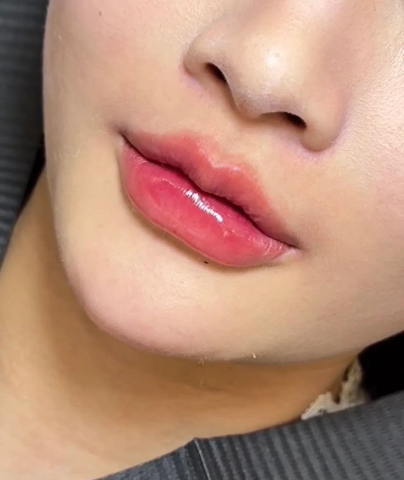 Chin filler result photograph 1