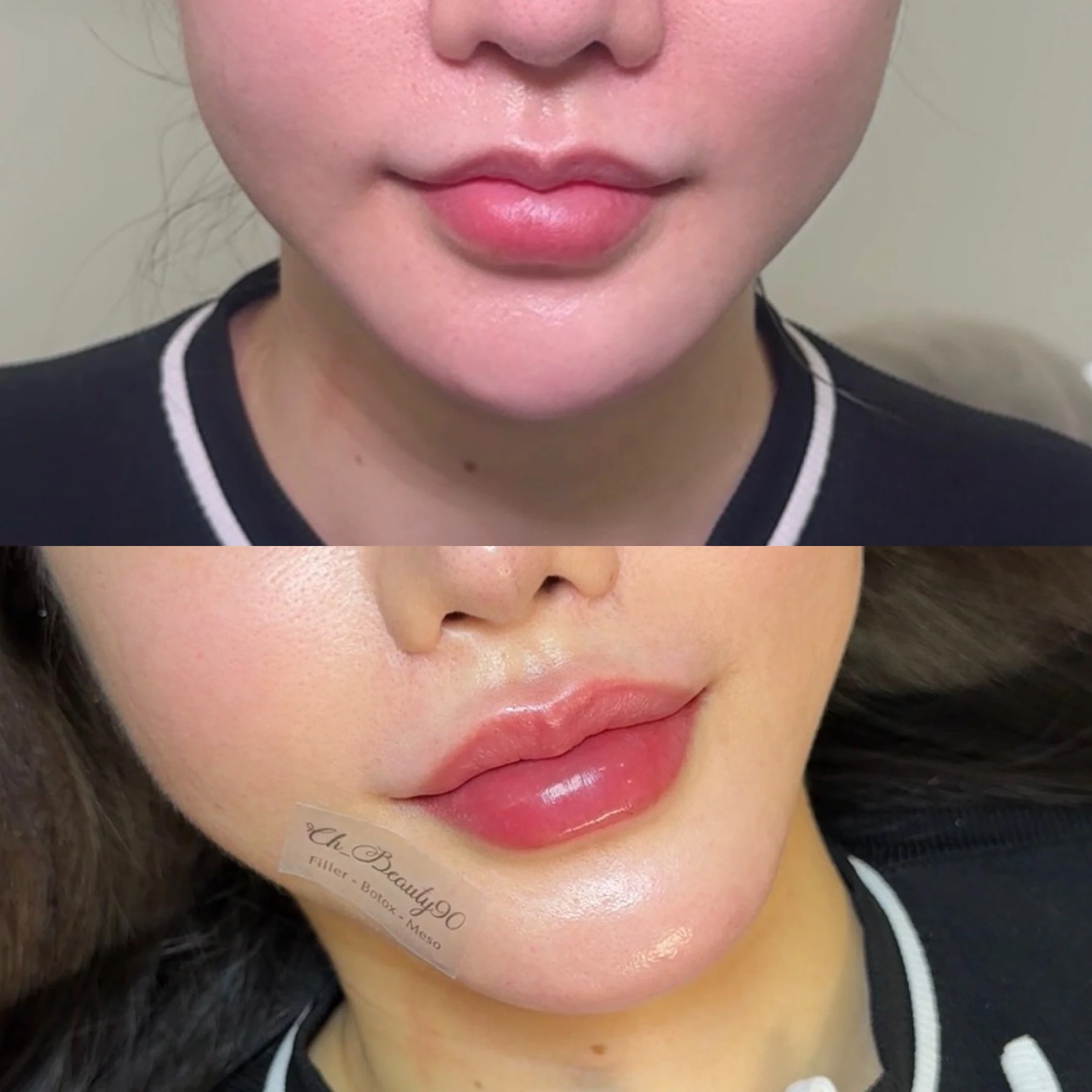 Chin filler result photograph 2