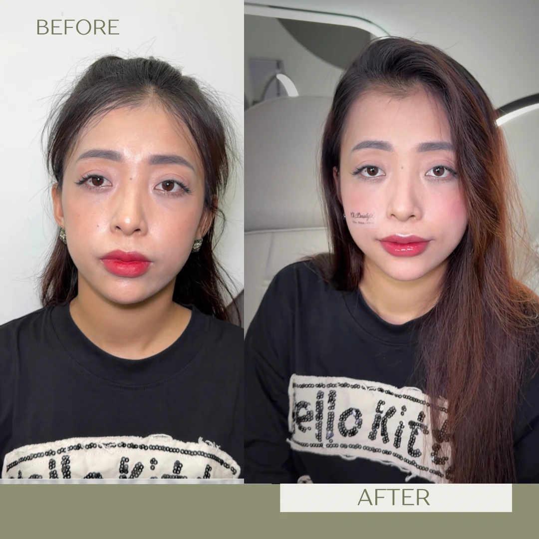 Before-and-after facial balancing result for a real client