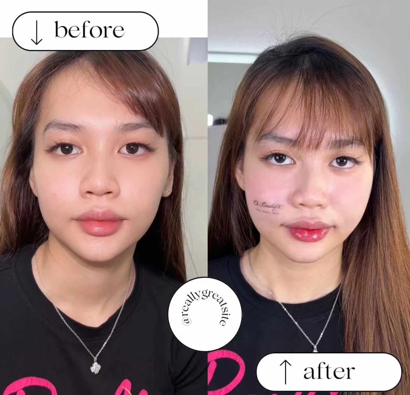 Real client facial balancing result shown before and after treatment
