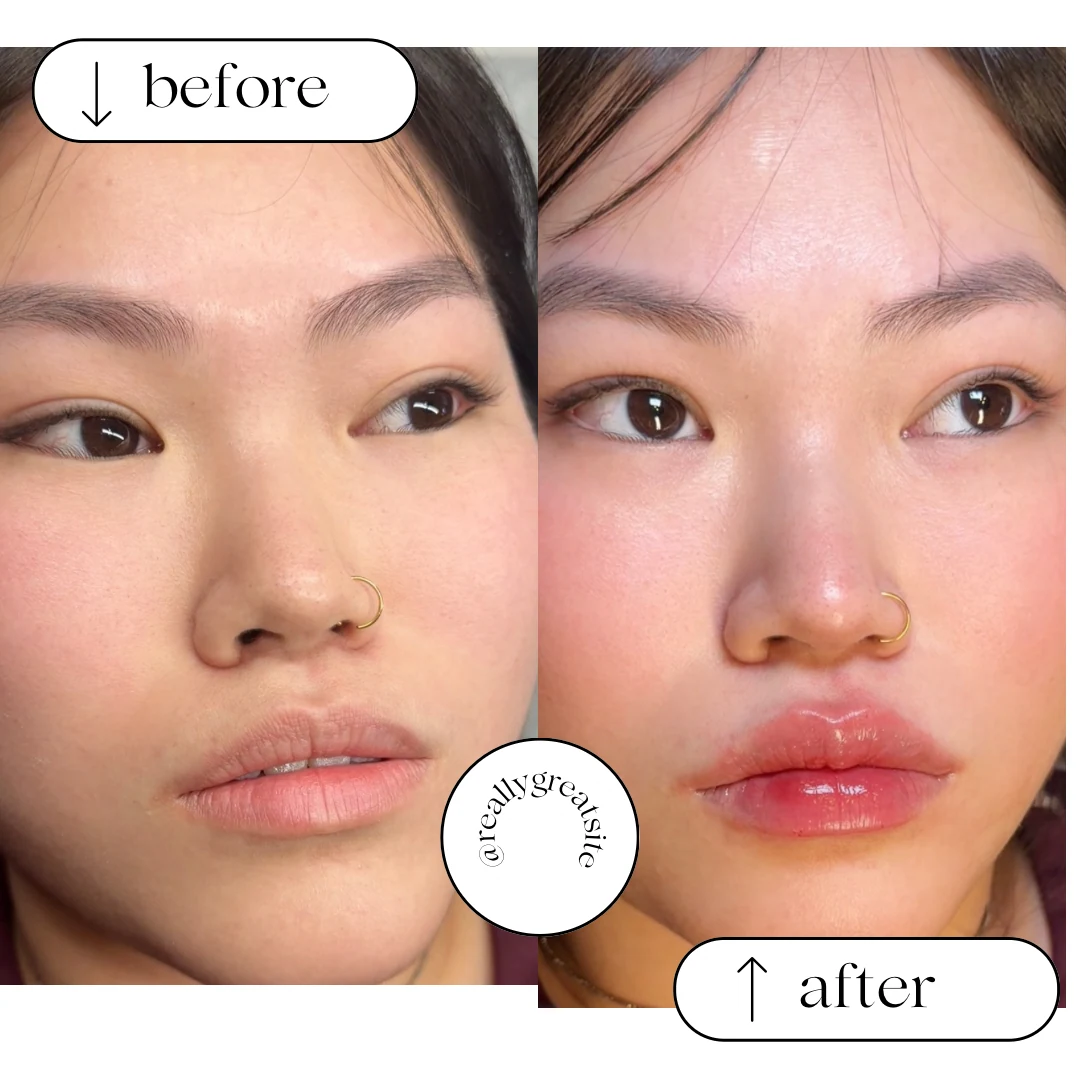 Lip filler result photograph 1
