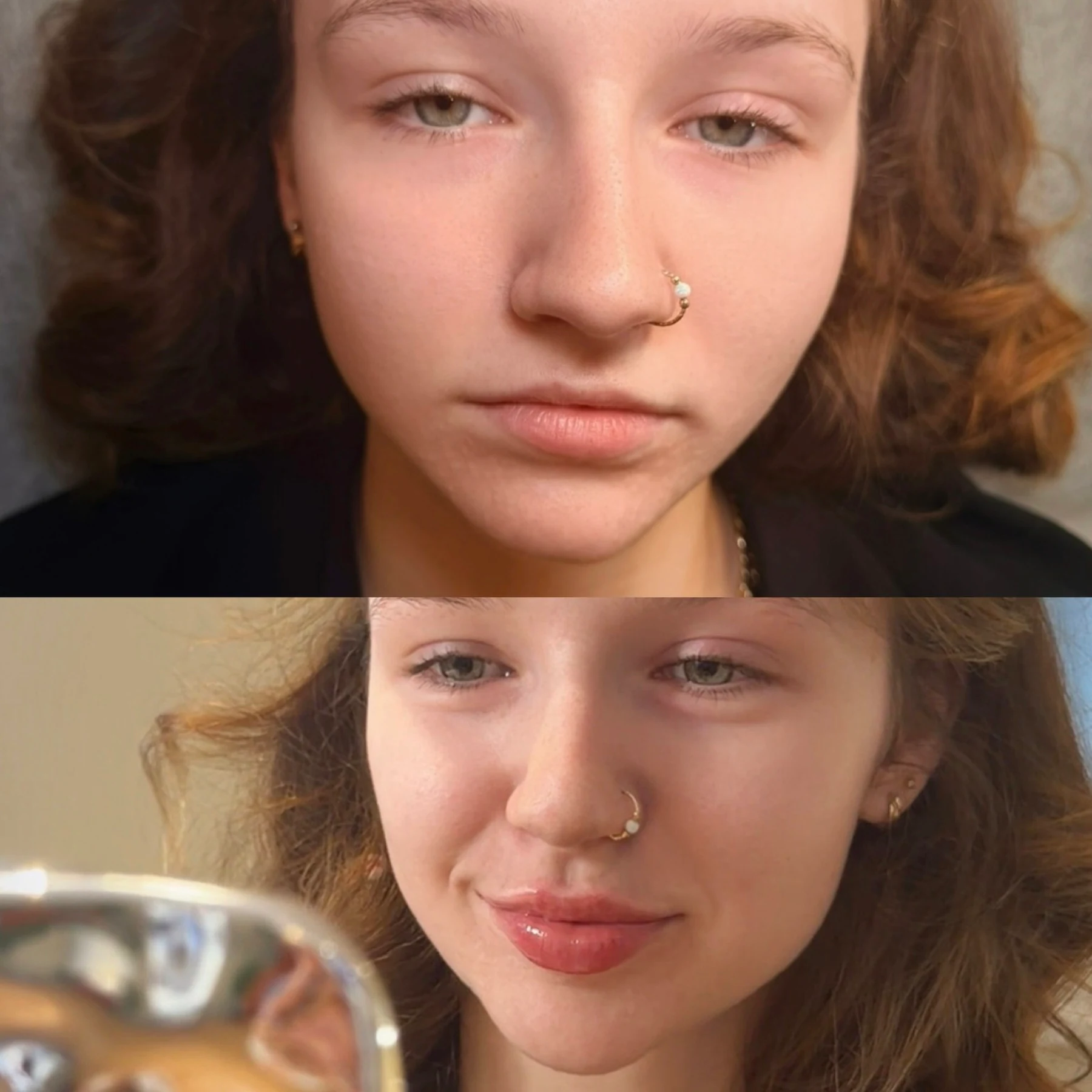 Lip filler result photograph 2