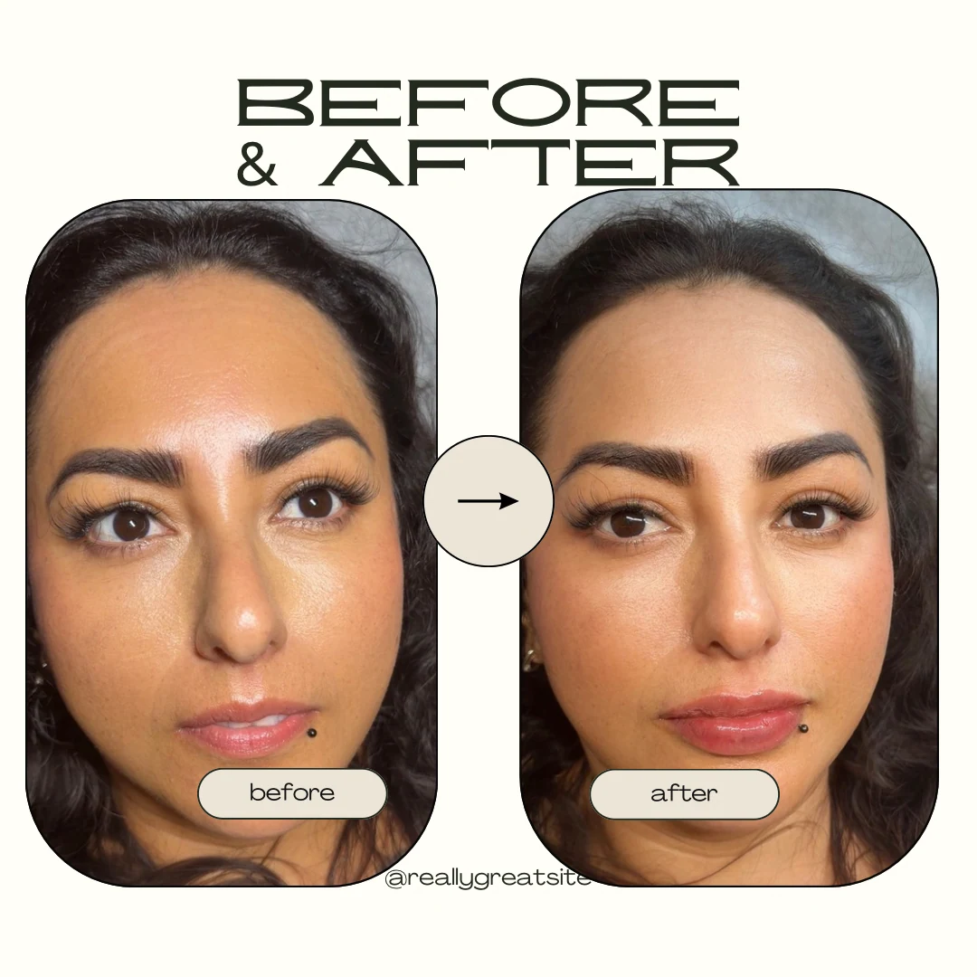 Lip filler result photograph 3