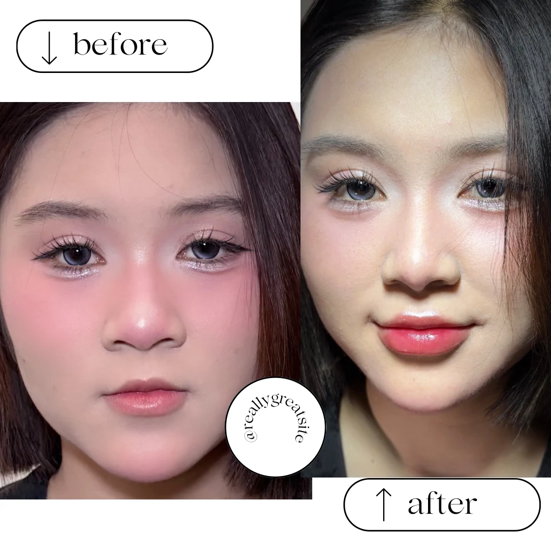 Lip filler result photograph 4
