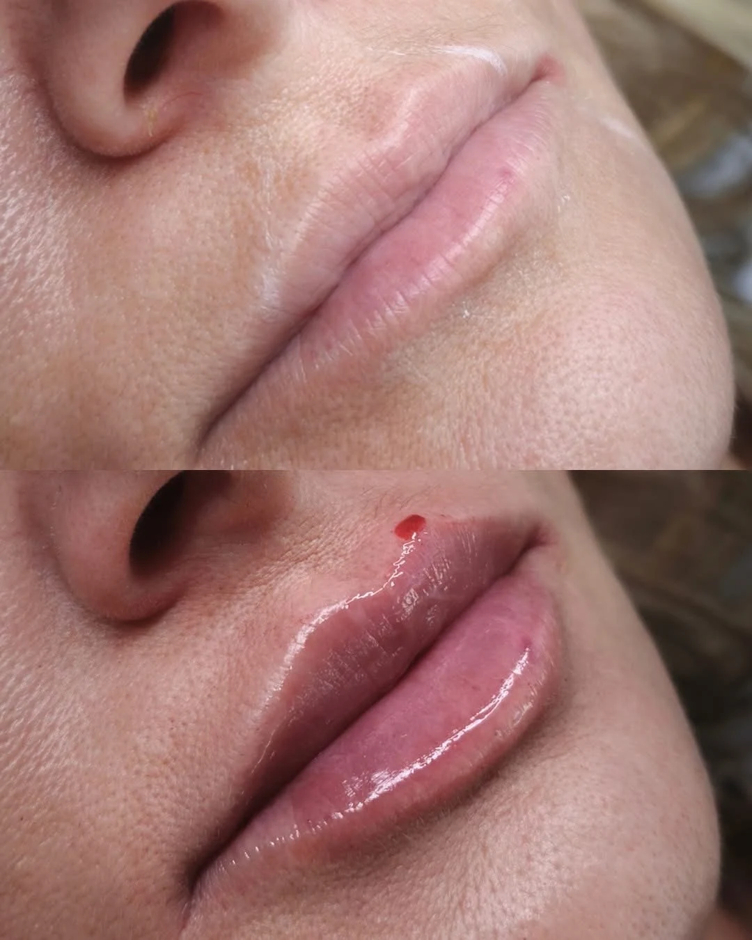 Lip filler result photograph 5
