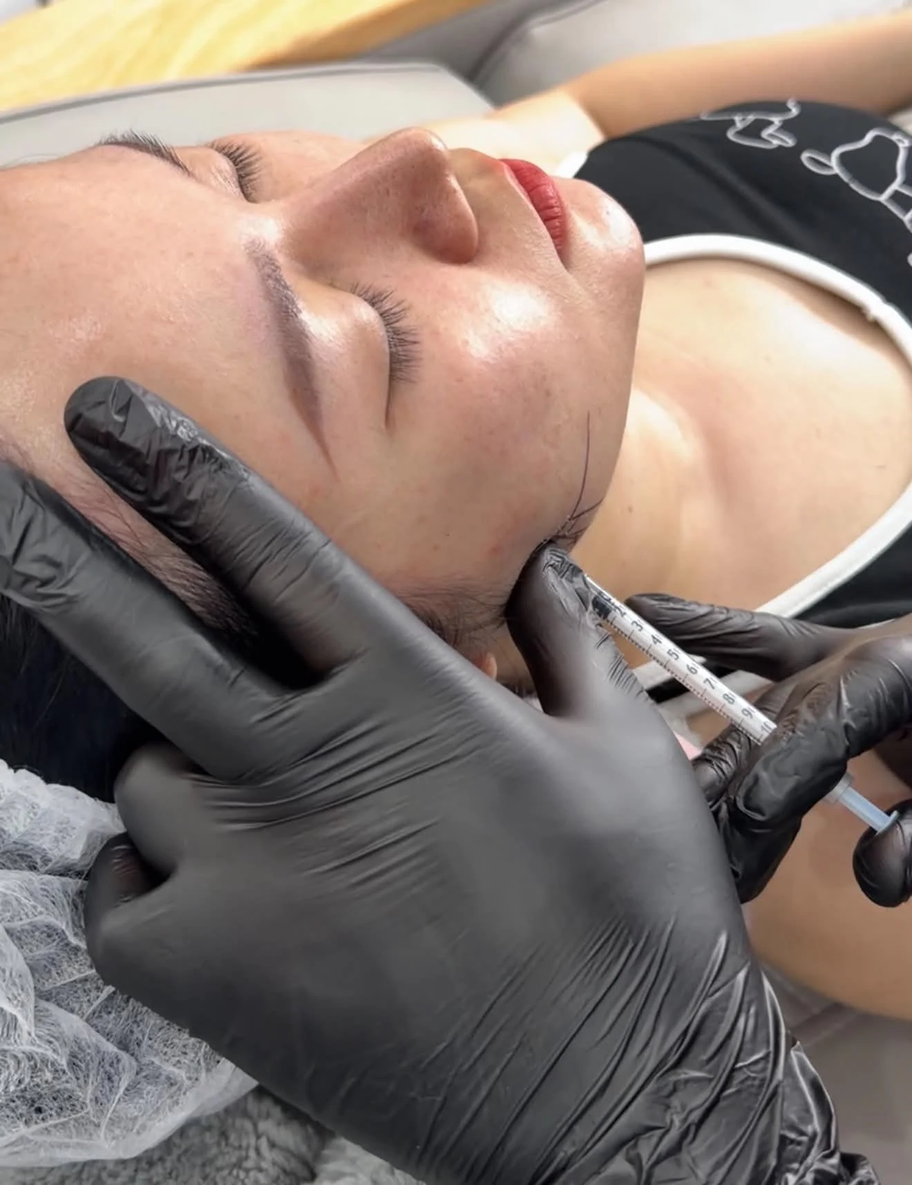 Masseter and jaw slimming treatment result photograph