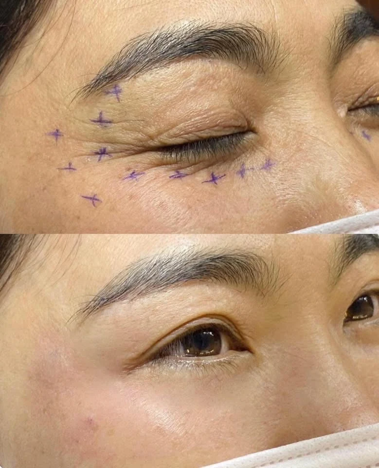 Wrinkle treatment result photograph