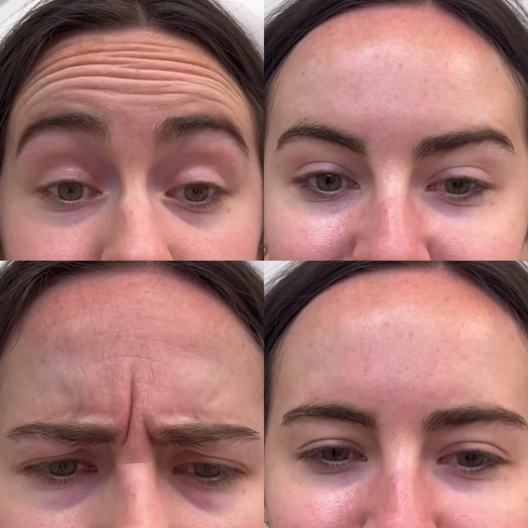 Wrinkle treatment facial result photograph